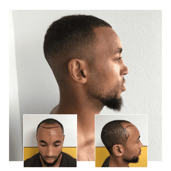 before after hair transplant harley street london 08