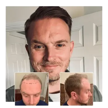 before after hair transplant ipswich suffolk 03