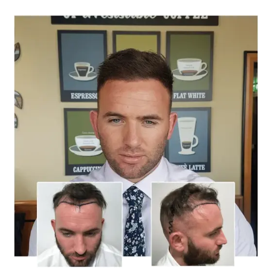 before after hair transplant manchester 05