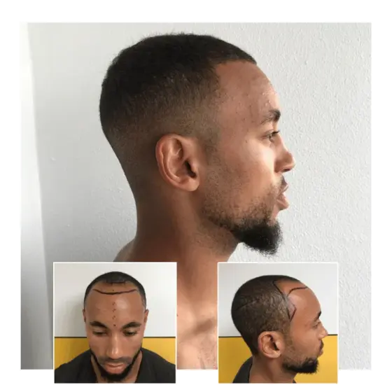 before after hair transplant oxford 08