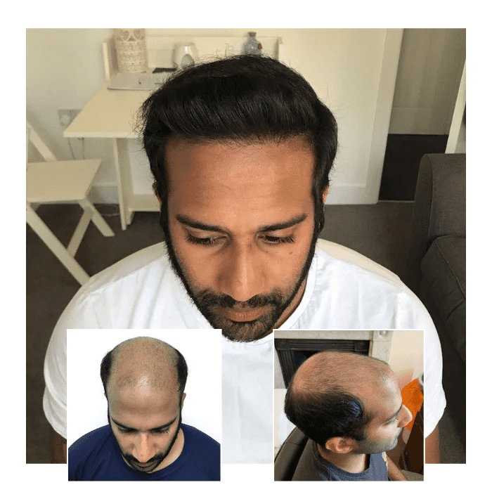before after hair transplant portsmouth 02