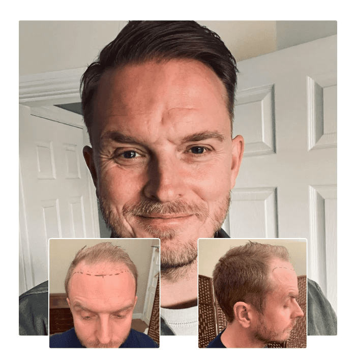 before after hair transplant portsmouth 07