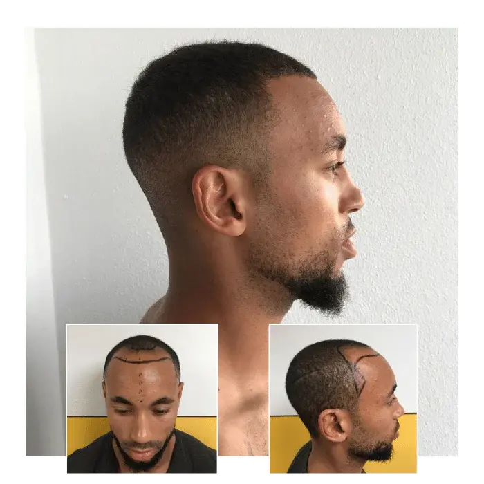 before after hair transplant southampton 08