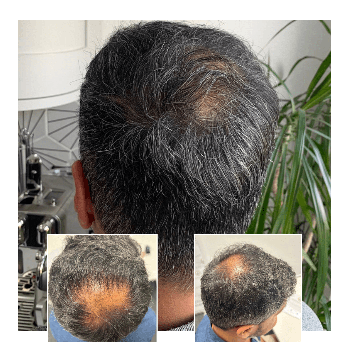 before after hair transplant laser therapy