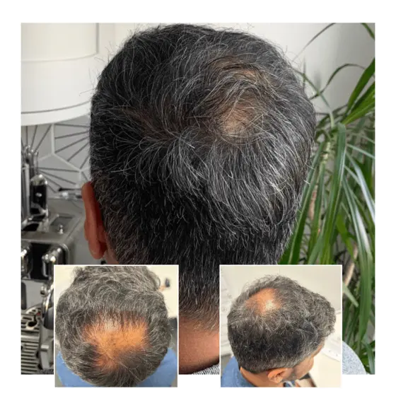 before after hair transplant laser therapy