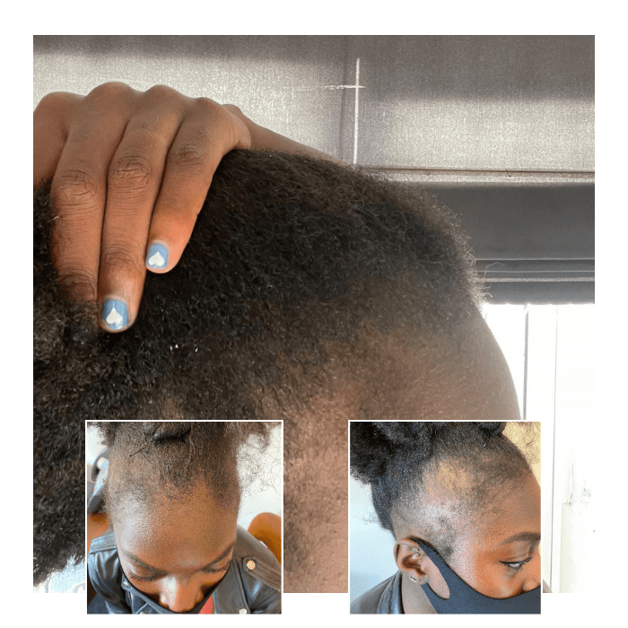 laser therapy for hair loss - woman afro