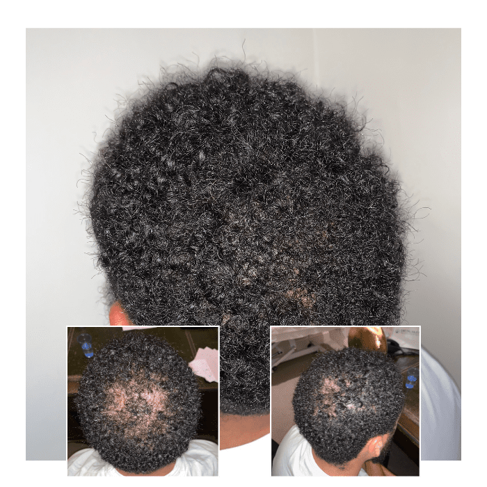 laser therapy for hair loss - afro