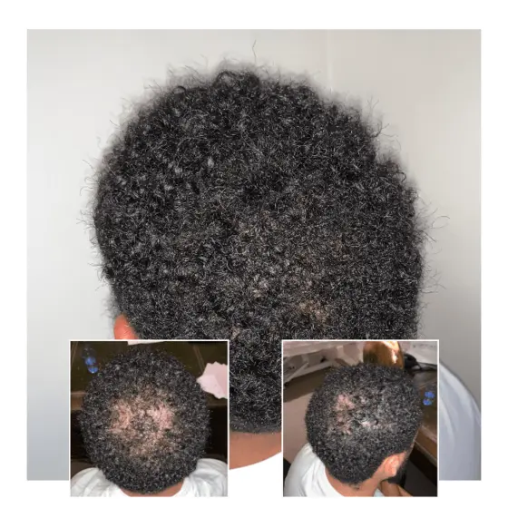 laser therapy for hair loss - afro