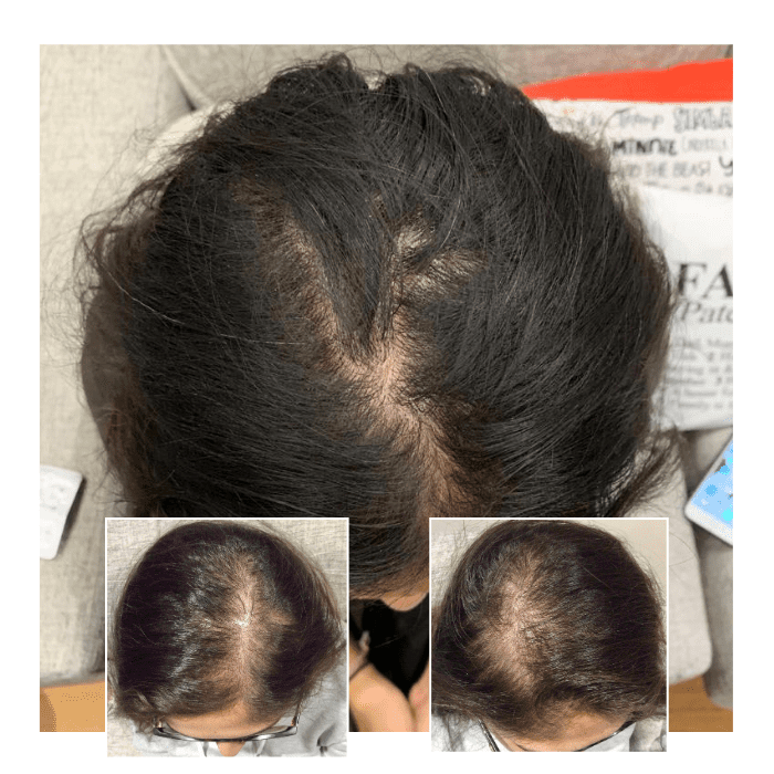 laser therapy for hair loss