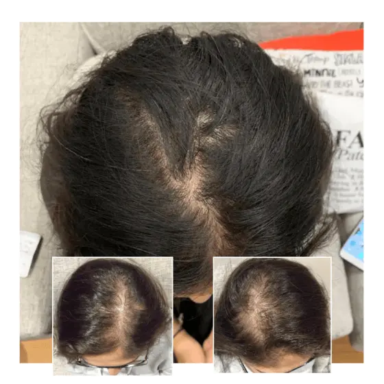 laser therapy for hair loss