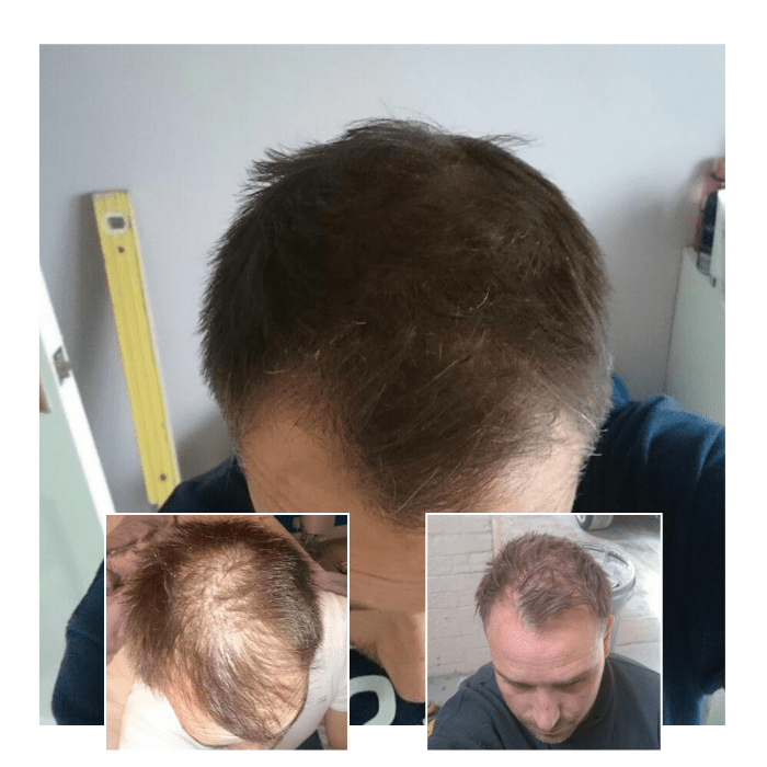 laser therapy for hair loss - male