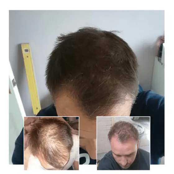 laser therapy for hair loss - male
