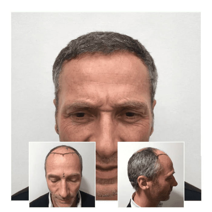 fue hair transplant before and after 02