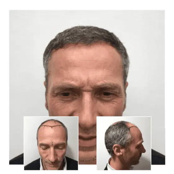 fue hair transplant before and after 02