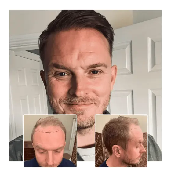 fue hair transplant before and after 03