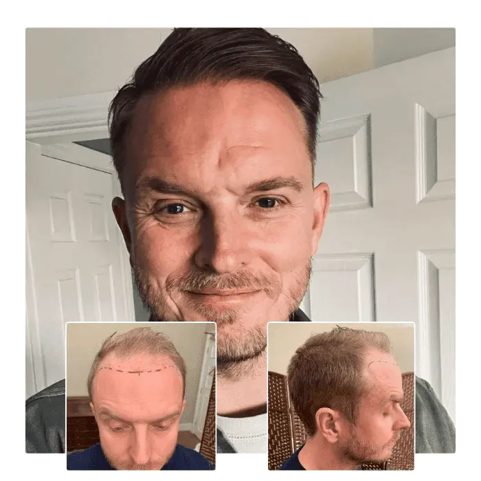 fut hair transplant before and after 1