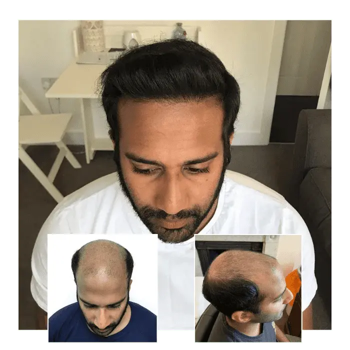 fut hair transplant before and after 3