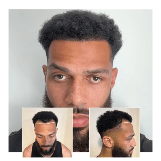 hair transplant male afro hair