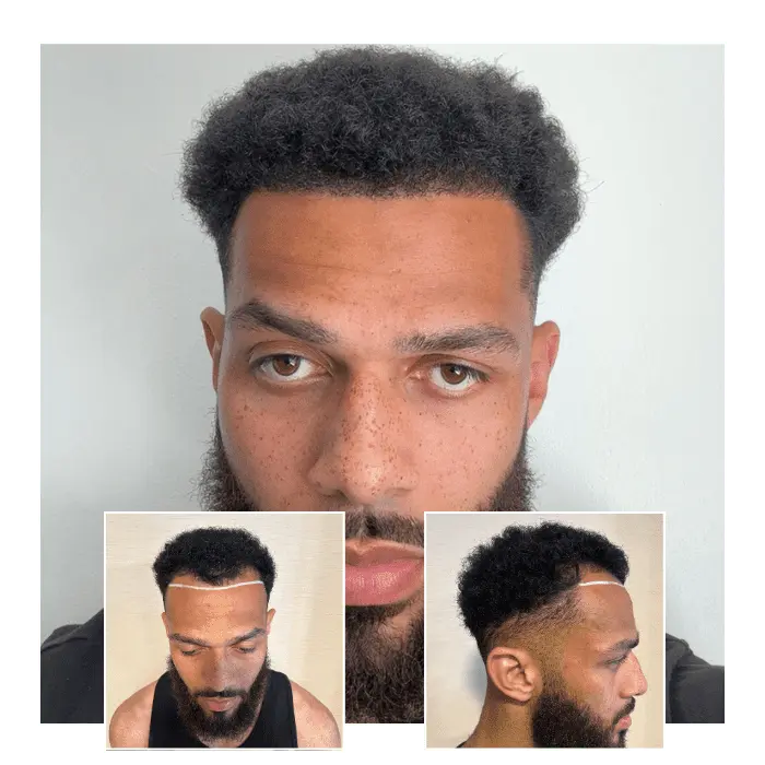 hair transplant male afro hair