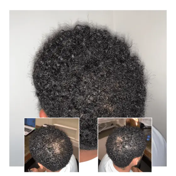 male afro hair transplant