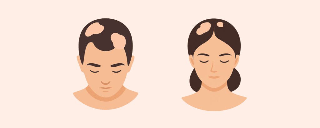 alopecia areata in men and women