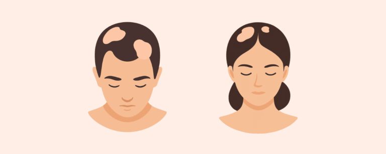 alopecia areata in men and women