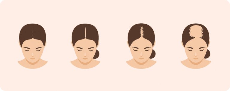 female pattern baldness