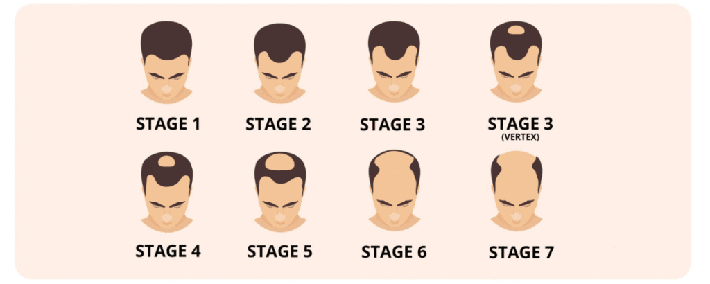 male pattern baldness