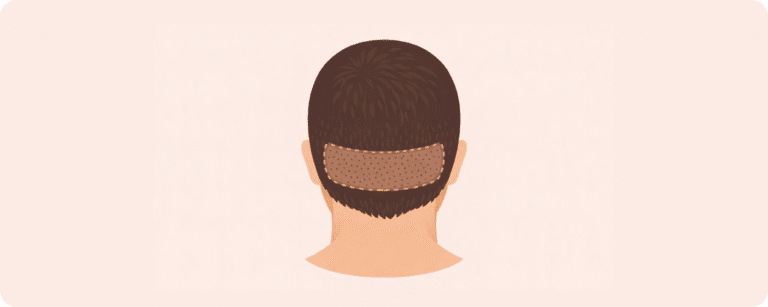 what is the doner area hair transplant