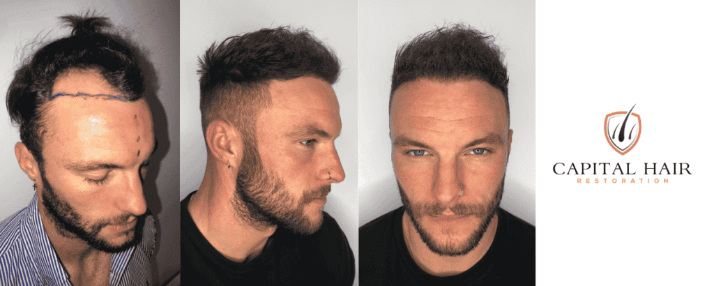 am i a good candidate for a hair transplant?