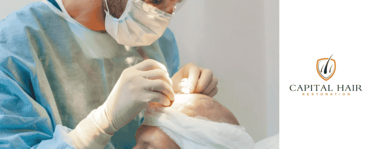 are hair transplants safe